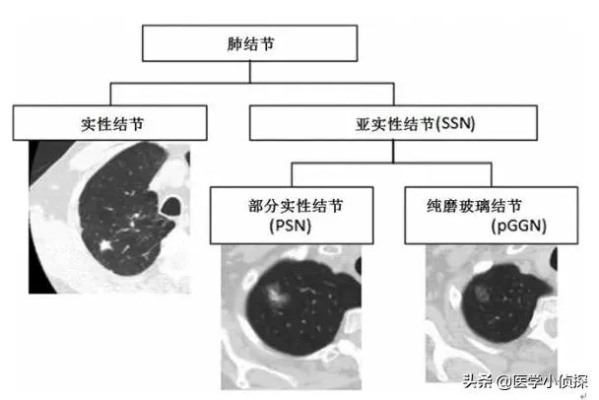 肺结节治疗首选国内顶尖专家推荐-第2张图片-www.211178.com_果博福布斯