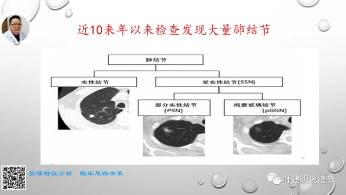 肺结节治疗首选国内顶尖专家推荐-第3张图片-www.211178.com_果博福布斯